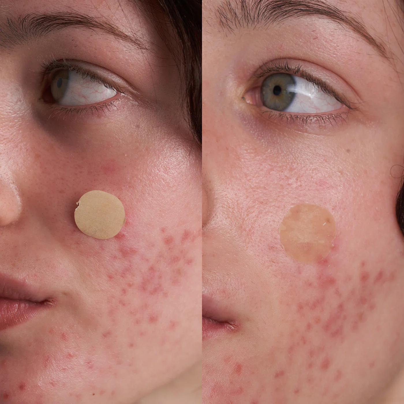 Blemish-Fighting Spot Dots image 4